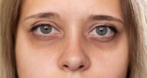 Dermatologist-Backed Solutions for Dark Circles